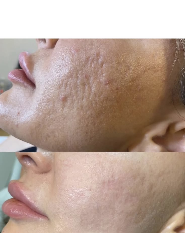 Lấy Nhân Mụn Có Để Lại Sẹo Không