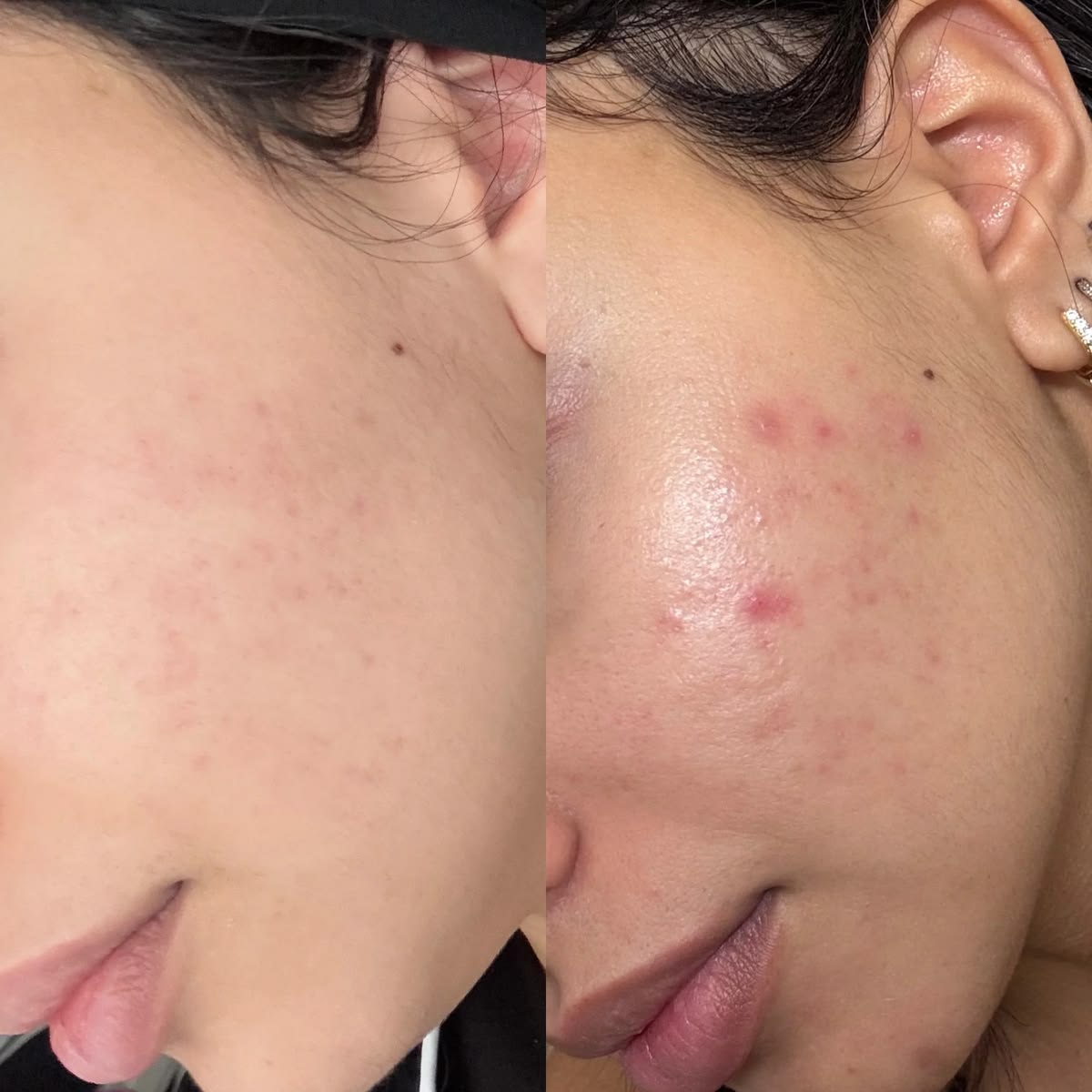 Những Thói Quen Khiến Da Ngày Càng Nhiều Mụn