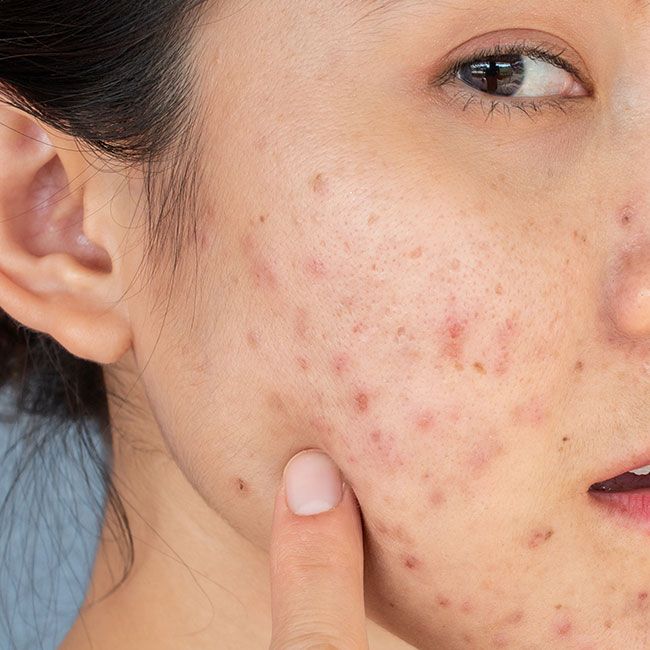 Những Thói Quen Khiến Da Ngày Càng Nhiều Mụn