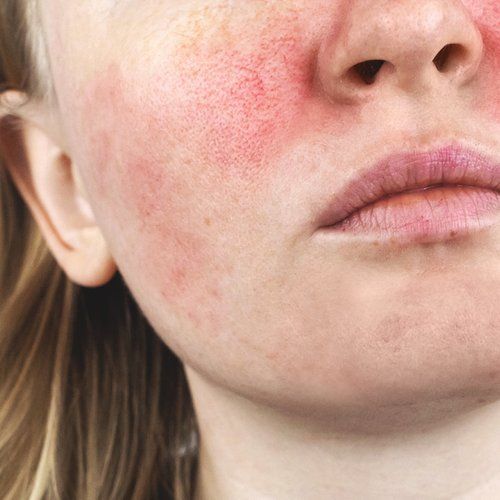  Tại Sao Lấy Nhân Mụn Xong Bị Đỏ Da