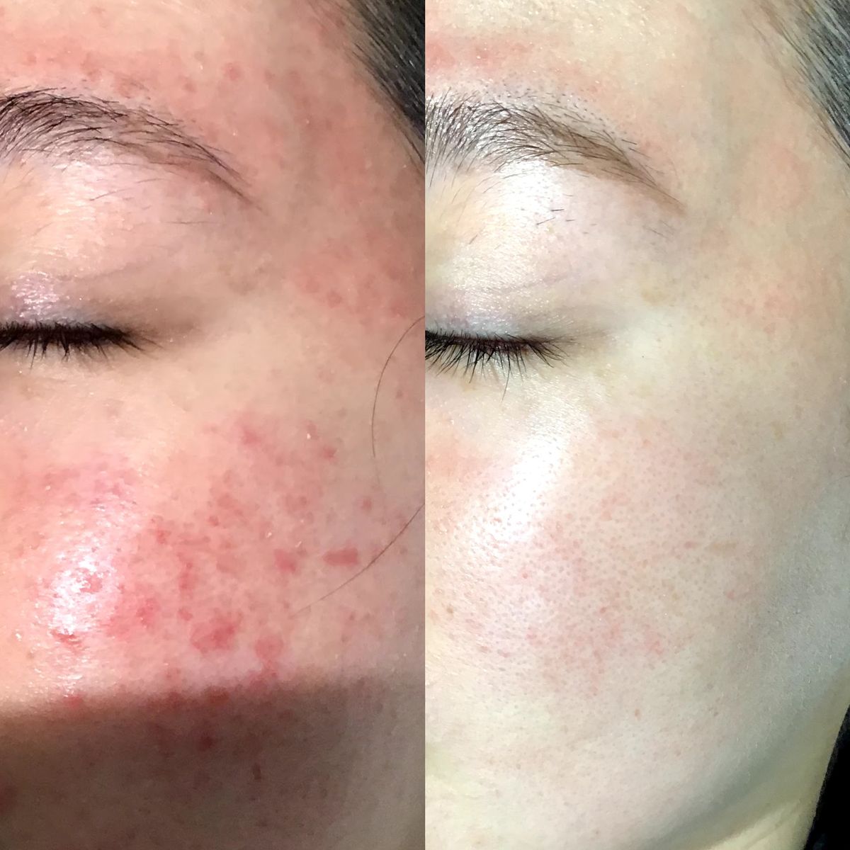 Tại Sao Lấy Nhân Mụn Xong Bị Đỏ Da