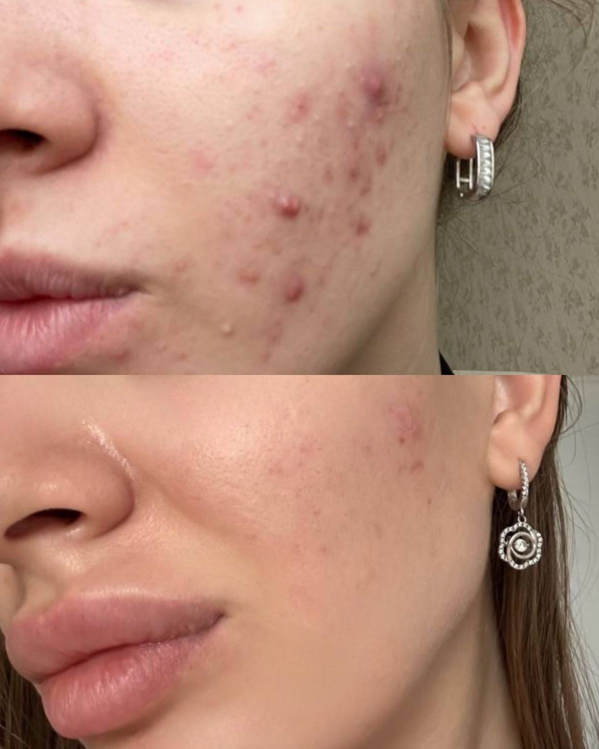 Vì Sao Dân Văn Phòng Dễ Bị Mụn?