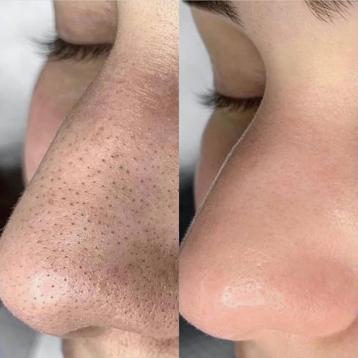 Mụn Đầu Đen Và Sợi Bã Nhờn Khác Nhau Ra Sao Mụn Đầu Đen Và Sợi Bã Nhờn Khác Nhau Ra Sao