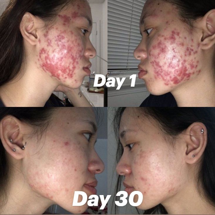 Những Loại Mụn Không Nên Nặn Để Tránh Thâm, Sẹo Và Biến Chứng Những Loại Mụn Không Nên Nặn Để Tránh Thâm, Sẹo Và Biến Chứng