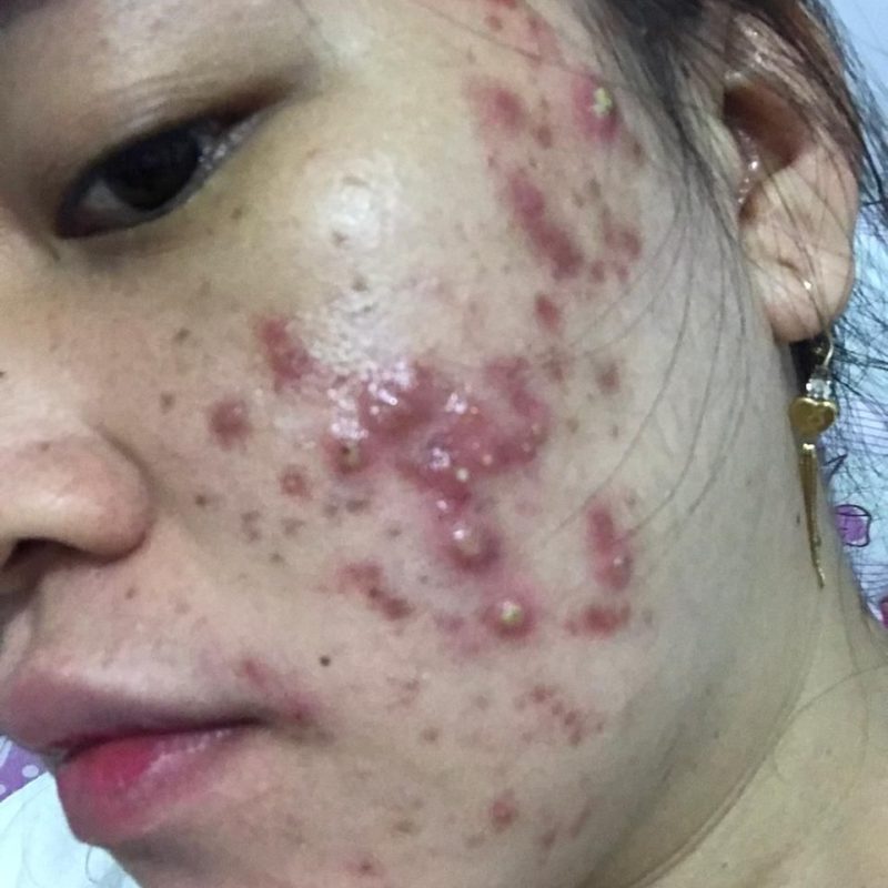 Những Loại Mụn Không Nên Nặn Để Tránh Thâm, Sẹo Và Biến Chứng
