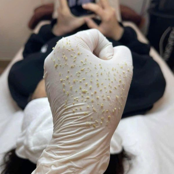 Sau Lấy Nhân Mụn Bao Lâu Được Trang Điểm