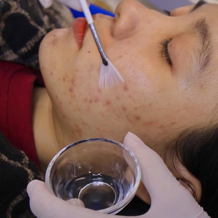 Tại Sao Sau Khi Nặn Mụn Cần Kết Hợp Peel Da? Góc Nhìn Từ Chuyên Gia