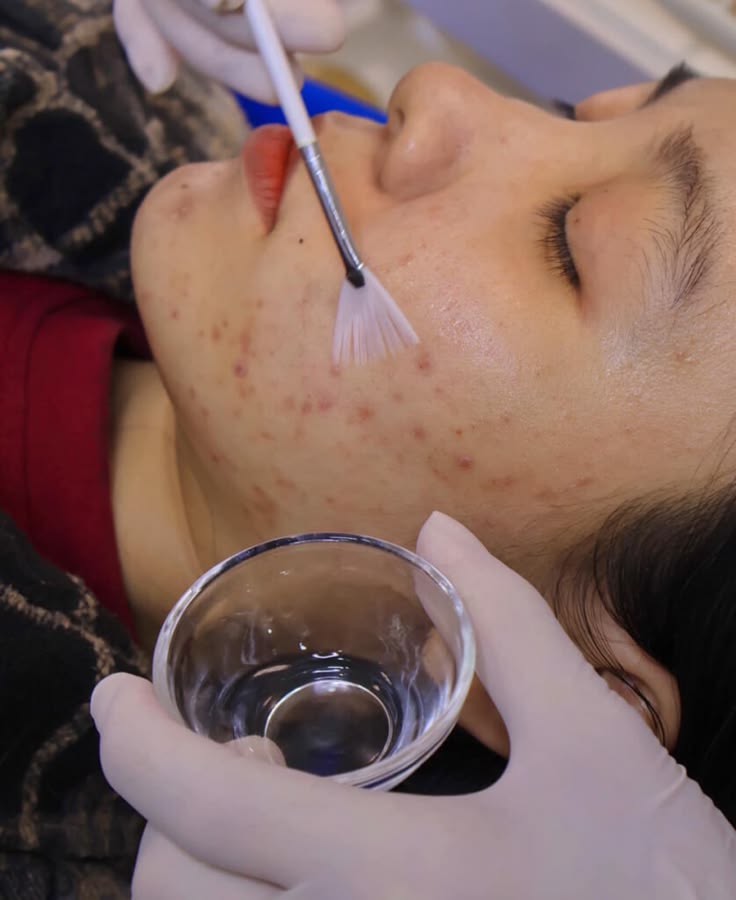 Tại Sao Sau Khi Nặn Mụn Cần Kết Hợp Peel Da? Góc Nhìn Từ Chuyên Gia