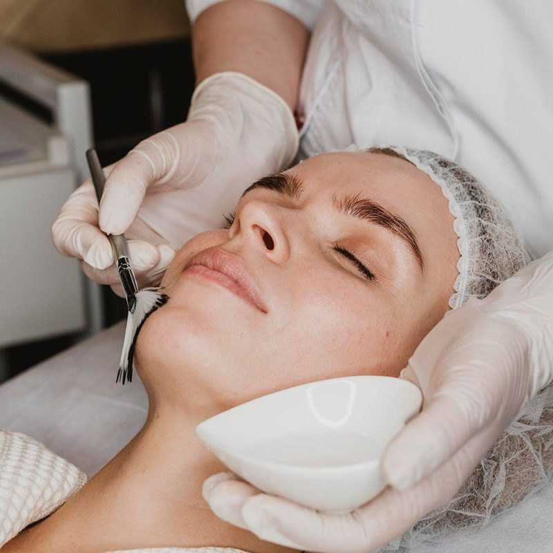 Tại Sao Sau Khi Nặn Mụn Cần Kết Hợp Peel Da? Góc Nhìn Từ Chuyên Gia
