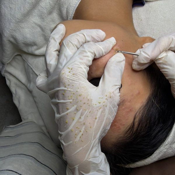 Vì Sao Lấy Nhân Mụn Là Bước Quan Trọng Trong Điều Trị Mụn?