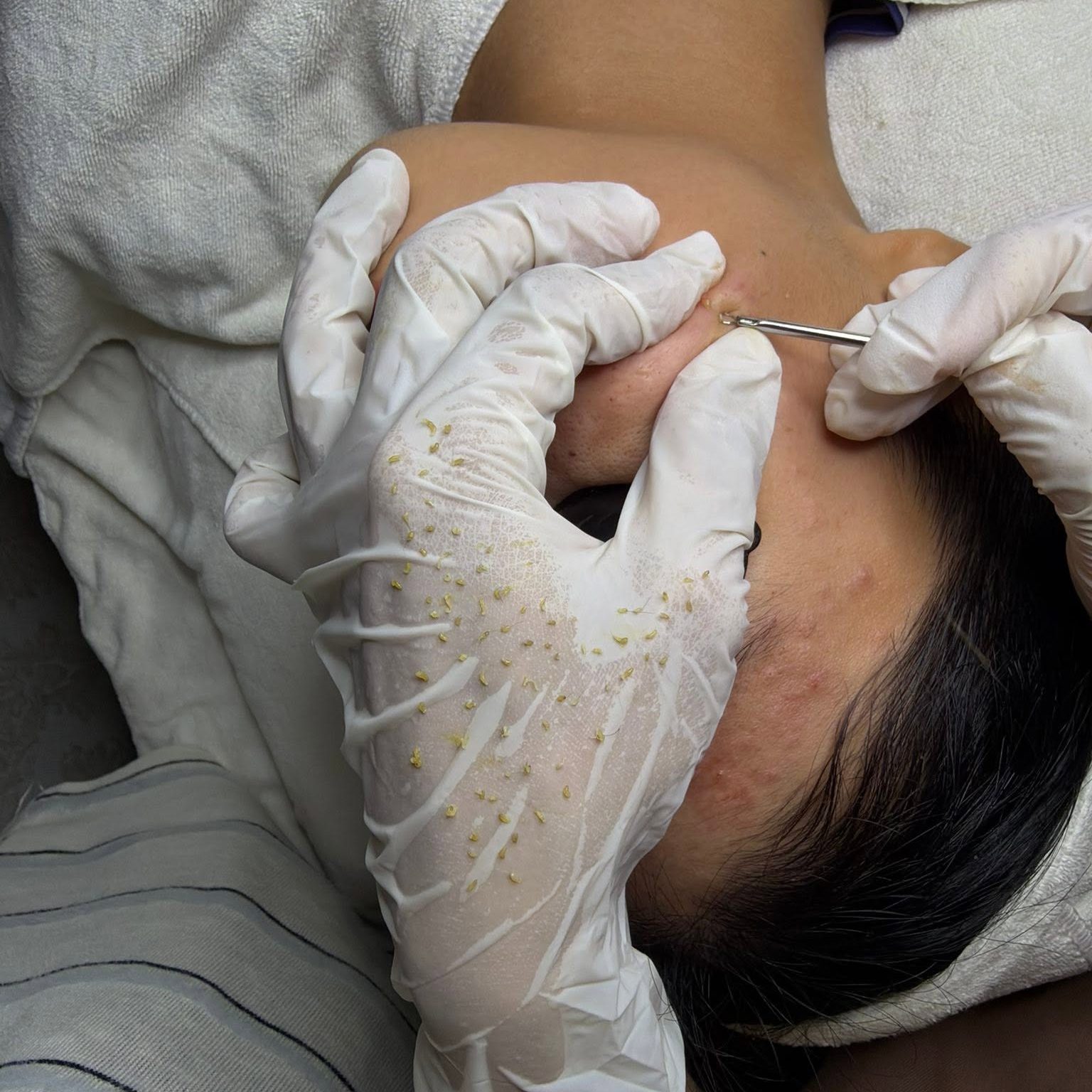 Vì Sao Lấy Nhân Mụn Là Bước Quan Trọng Trong Điều Trị Mụn Vì Sao Lấy Nhân Mụn Là Bước Quan Trọng Trong Điều Trị Mụn?