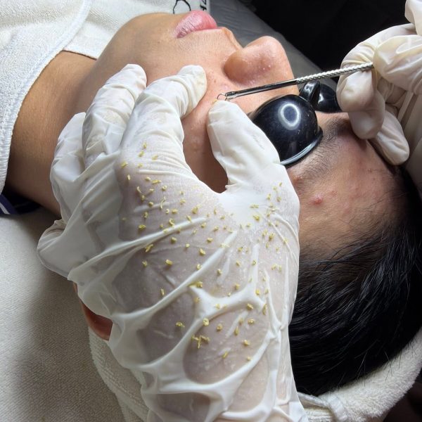 Vì Sao Lấy Nhân Mụn Là Bước Quan Trọng Trong Điều Trị Mụn?