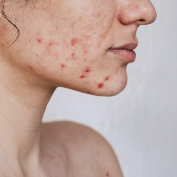 Vì Sao Mụn Thường Xuất Hiện Ở Cằm?